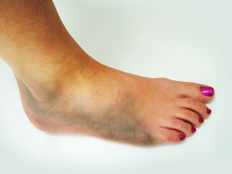 Relieve Leg Pain by Consulting a Varicose Veins Doctor in the Bay Area for Effective Care