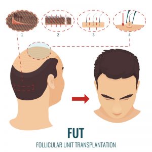 What You Should Know When Considering Hair Restoration in PA
